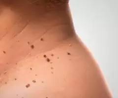 Remoção a laser de pintas e verrugas